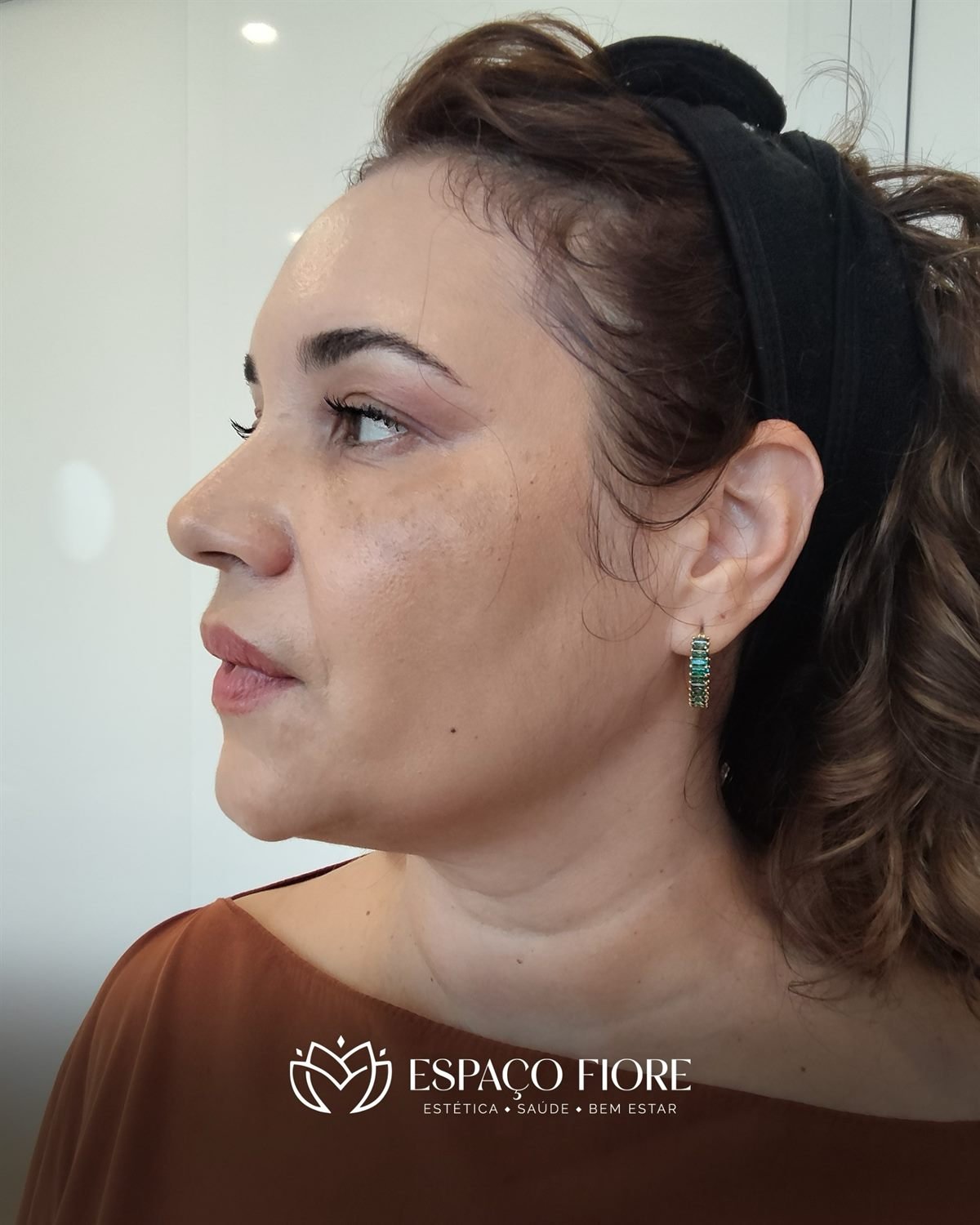 Paciente de perfil, depois do tratamento