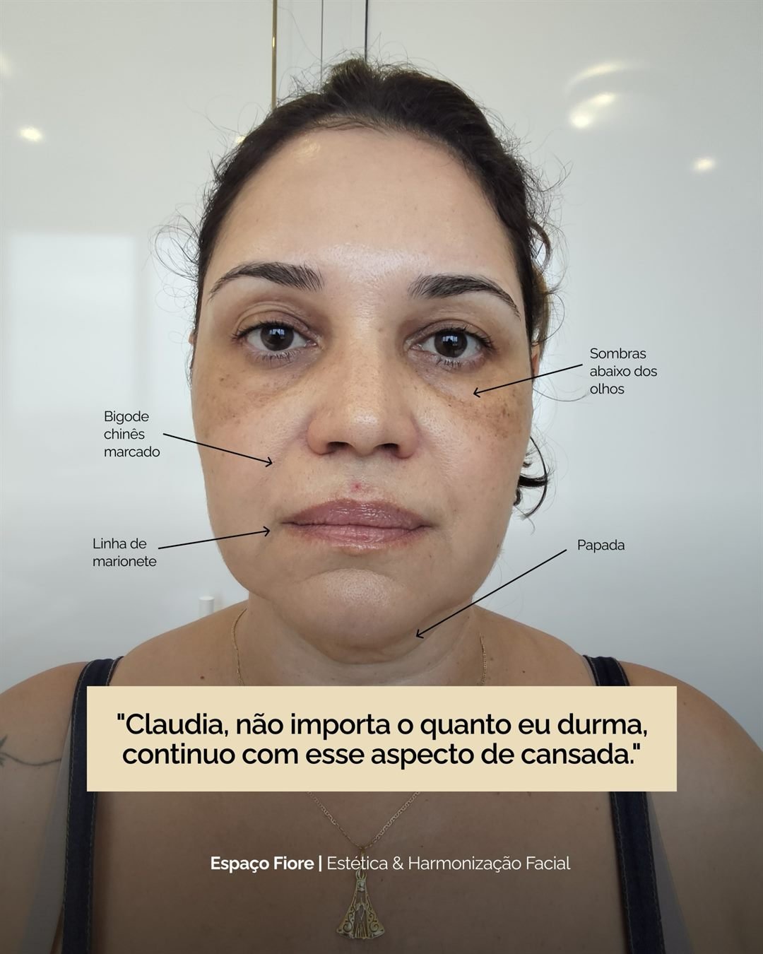 Paciente antes do tratamento, com as queixas marcadas: sombras abaixo dos olhos, bigode chinês, linha de marionete e papada